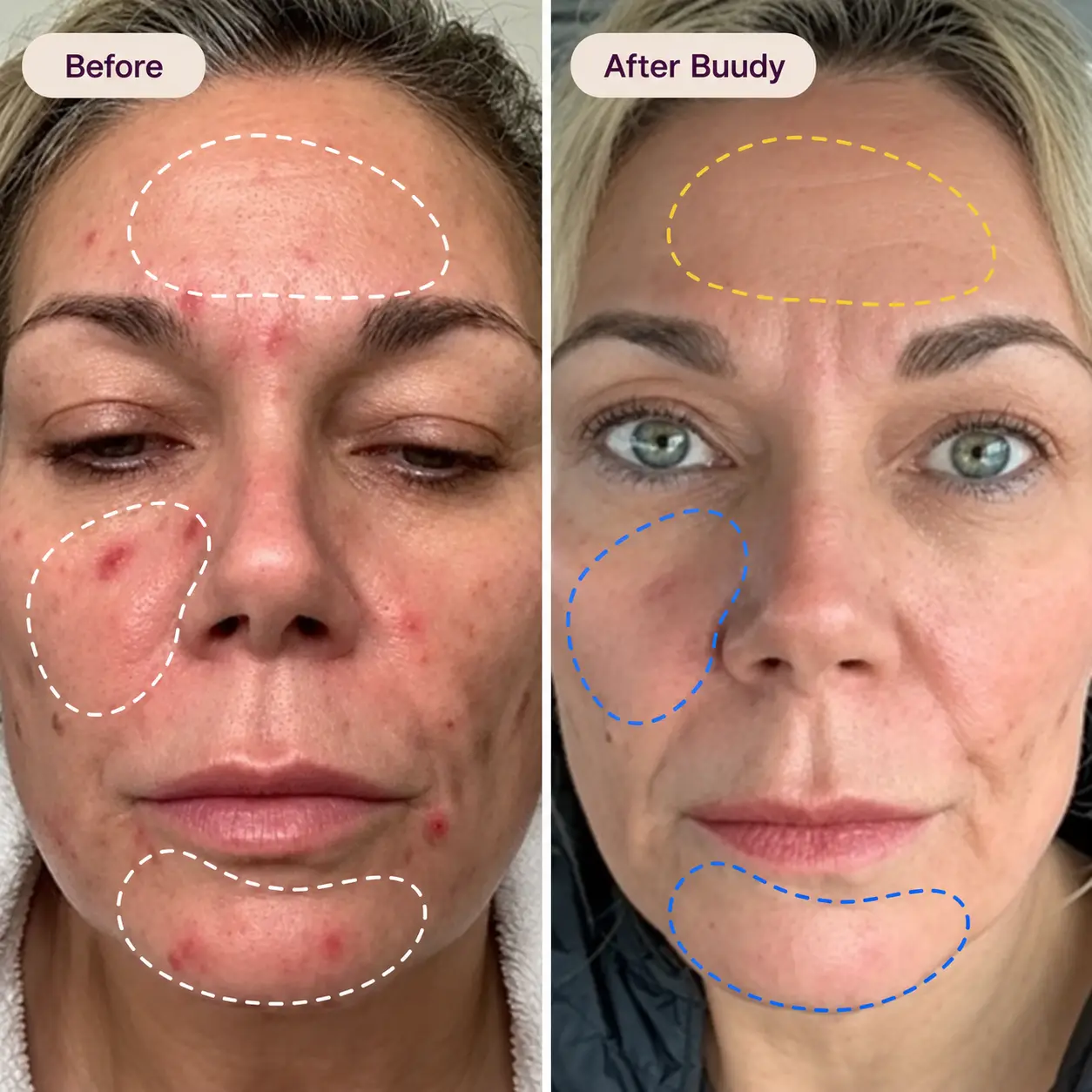 Buudy 7 Colour LED Mask before and after clinical results: clears active acne breakouts and calms inflamed complexion UK